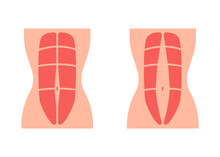 Normal Tone Muscle Abdomen And Diastasis Recti, Weak And Divergence Abdomen Muscle. Rectus Abdominal Diastasis. Vector Illustration