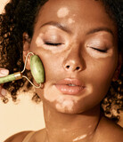 Fototapeta Konie - Woman with vitiligo uses a green jade roller, close-up. Facial treatment with skin features