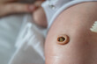 CLose up on belly of newborn baby with umbilical cord dried stump umbilical granuloma overgrowth of tissue during the healing process of the belly button