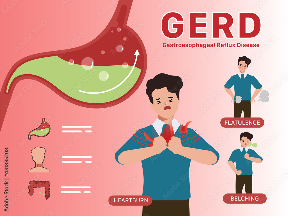 Infographic of Gastroesophageal reflux disease (GERD) Stock Vector ...