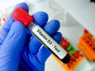 Wall Mural - Blood sample for vitamin D3 test