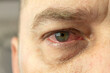 © Jan Kravtsov - Close-up of a red and inflamed eye