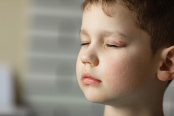 Portrait of a Caucasian boy with a black eye.