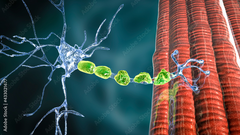 Demyelinating Process Demyelination of a neuron, the damage of the neuron myelin sheath seen ...