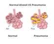 Normal lung alveoli versus pneumonia.