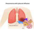 Pneumonia with pleural effusion. Close up of the alveioli with pus