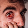 © Javier Bravo/ADDICTIVE STOCK - Closeup of crop male with red inflamed eye looking at camera and touching face