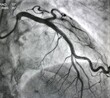 Normal coronary angiogram of left coronary artery during cardiac catheterization.