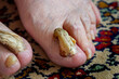 toenail that thickens and lengthens due to nail fungus. Nail disease. Old woman with fungal infection of the toenails.