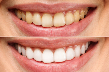 Wall Mural - woman teeth before and after whitening. Over white background. Dental clinic patient. Image symbolizes oral care dentistry, stomatology.