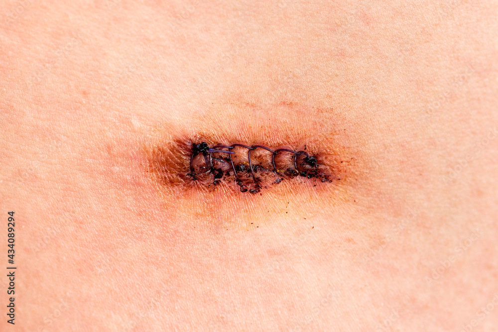 String Wounds Small Row of stitches holding together the edges of a wound Stock Photo ...