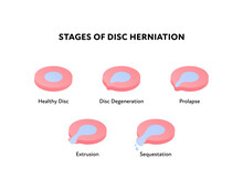 Spine Disk Stages Of Herniation. Vector Flat Anatomical Illustration. Icon Set. Healthy, Degeneration, Prolapse, Protrusion, Sequestation Stage. Design For Science, Biology, Health Care.