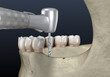 Cleavage of the alveolar ridge, augmentation. Dental surgery, 3D illustration