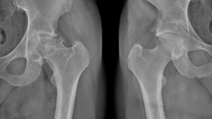 X-ray of a painful hip in a man with osteoarthritis of the left hip joint in the red area, very painful, difficult to walk, worn out joint, endoprosthetics. Surgical work required