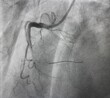 coronary angiogram shown massive thrombus that occluded right coronary artery (RCA) in patient with ST elevation myocardial infarction (STEMI) with no-reflow.