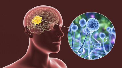 Wall Mural - Brain mucormycosis, a brain lesion caused by fungi Mucor