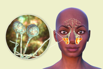 Sticker - Mucor fungi as a cause of sinusitis, 3D illustration