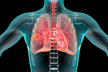 Sticker - Lung mucormycosis, a lung disease caused by fungi Mucor, also known as black fungus