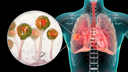 Sticker - Lung mucormycosis, a lung disease caused by fungi Mucor, also known as black fungus