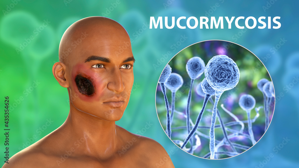 Cutaneous mucormycosis, or skin mucormycosis, a disease caused by fungi ...