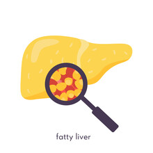 Unhealthy Fatty Liver. Damaged Human Organ Under Magnifying Glass. Medical Research Study Of Fat Liver Tissue. Vector Illustration In Flat Cartoon Style Isolated On White.