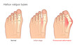 Medical vector illustration of Hallux valgus types. Healthy foot, initial stage and pronounced deformation. 