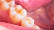 © Yaya Photos - Symptoms of demineralization of the teeth. Visible signs of caries in the interstices of the enamel of  the tooth. Dental damaged erosion concept. Loss of the reinforcement of the enamel.