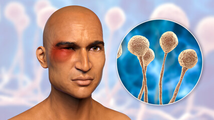 Poster - Periorbital cutaneous mucormycosis, a disease caused by Mucor fungi