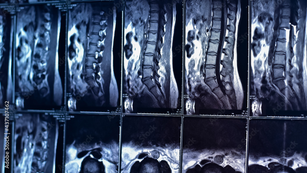 Magnetic resonance imaging of the lumbar spine. Stock Photo | Adobe Stock