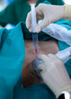 Anesthetist press ultrasound probe and injection more medication on the patient’s back for release pain in Epidural analgesia or Epidural nerve block procedure.