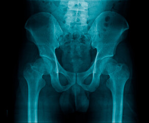 Sticker - degenerative change of hip joint, old man pain at hip joint, x-ray pelvic bone and hip jiont for visible diagnosis hip joint pain cause