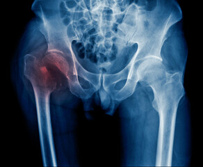 Wall Mural - x-ray hip fracture of old man, x-ray image intertrochanteric fracture