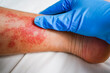 Disease of the skin on the legs, itchy red rashes and spots