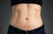 Heat rash on stomach of  woman.  Fit female torso with prickly heat or miliaria from physical activity. Fluid-filled red blisters and bumps visible in different stages of healing. Dark background.