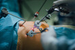 © Marko/Stocksy - Laparascopic surgery