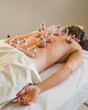 © Irina Efremova/Stocksy - Cupping installed on lower back