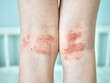 © Alyona Shu - Eczema on kid's legs. Atopic dermatitis close up. Allergy spots and red itchy skin inflammation on child's feet