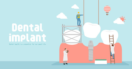 Dental implant concept vector banner illustration