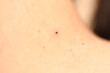 Injured drying hanging birthmark on the neck.