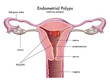 Medical illustration shows a female reproductive system with endometrial polyps, with annotations.