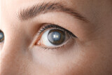 Fototapeta  - Closeup view of woman suffering from cataract