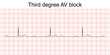 Electrocardiogram show third degree (complete) AV block pattern. ECG. EKG. Vital sign. Heart beat. Life line. Medical healthcare symbol.