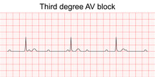 Electrocardiogram show third degree (complete) AV block pattern. ECG. EKG. Vital sign. Heart beat. Life line. Medical healthcare symbol.