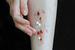Eine Frau reibt ihr blutendes, verletztes Bein mit einer Heilsalbe ein