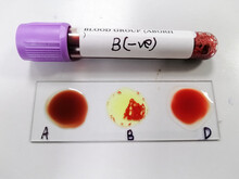 Blood Group Testing By Slide Agglutination Method With Sample,show Result  B Negative