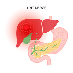 Sticker - Liver disease concept