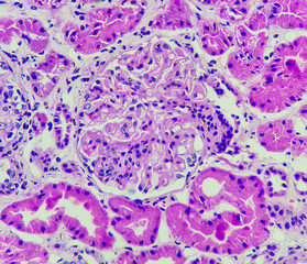 Poster - Photo of lupus nephritis, showing endocapillary hypercellularity, H&E stain, magnification 400x, photo under microscope