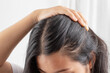 Women allergic to shampoo causing hair loss, baldness, dandruff