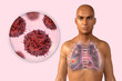 Lung cancer, medical concept