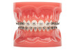 Orthodontic model demonstration teeth model of orthodontic bracket or brace. Metal braces on teeth on an artificial jaws closeup
